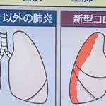【拡散希望】新型コロナの肺炎と新型コロナ以外の肺炎の違いとは...