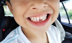 ”歯医者さんが教える”事故で大人の歯が抜けたり折れたりしたら〇〇に入れる？！