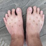足の表にできた謎の斑点の病名を調べたときの驚きの結果とは!!