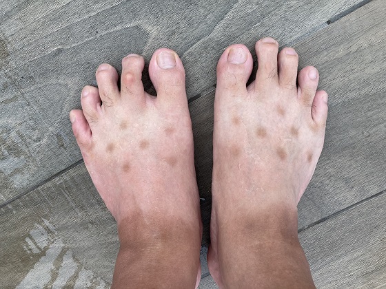 足の表にできた謎の斑点の病名を調べたときの驚きの結果とは！！